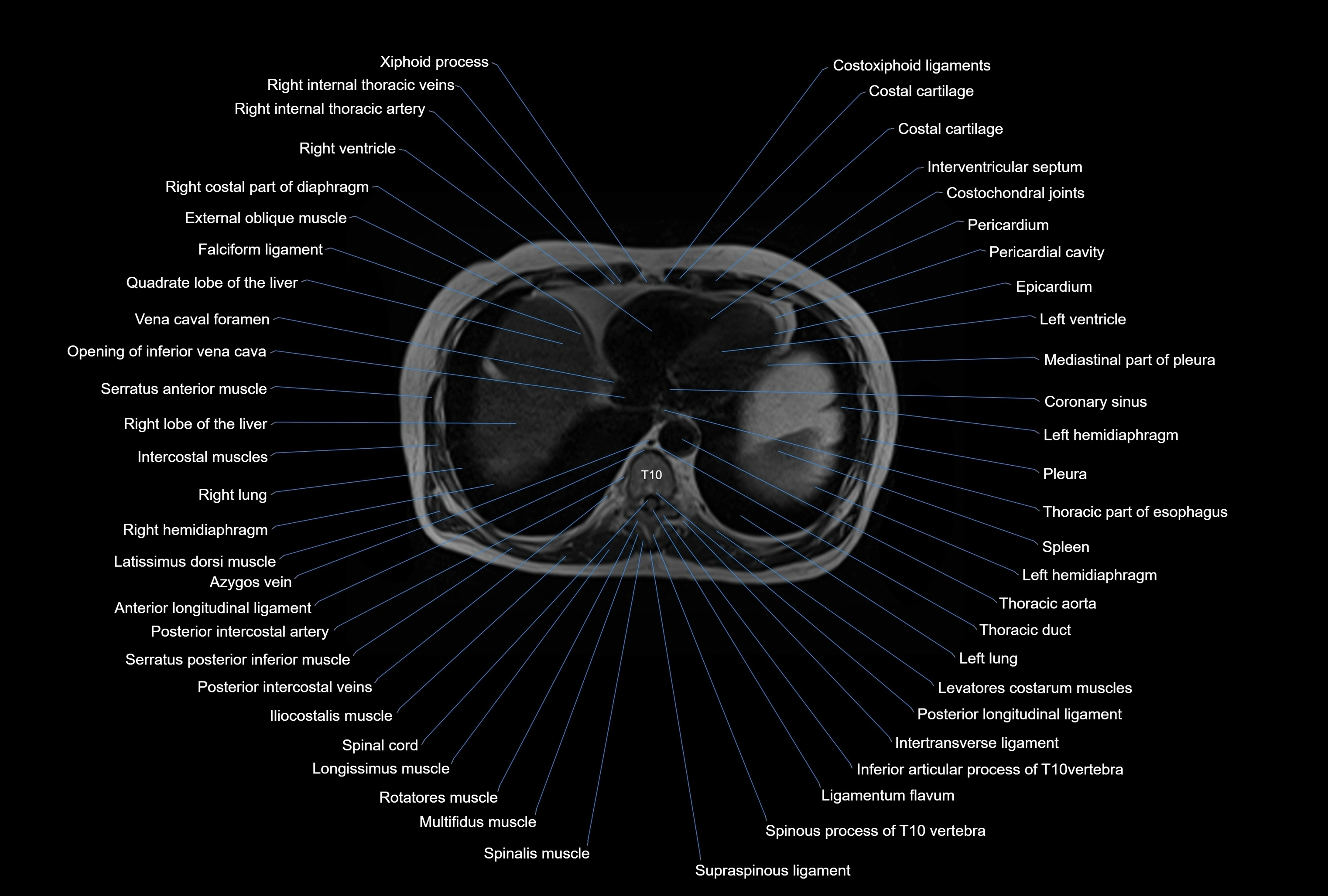 MRI Abdomen axial cross sectional anatomy radiology  image-img-00001-00004.webp